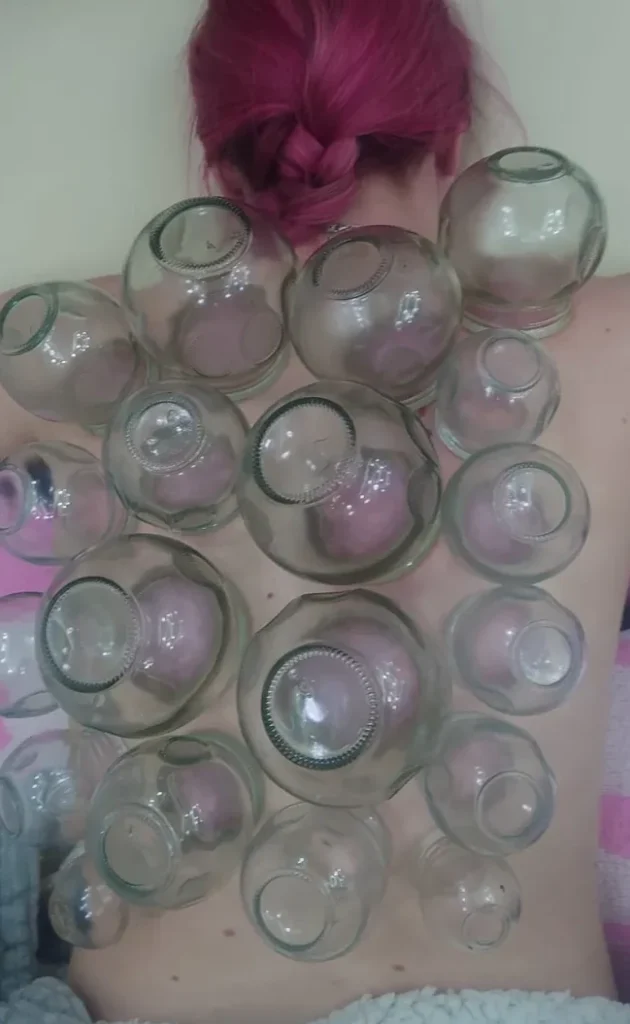 Terapia bańkami ogniowymi