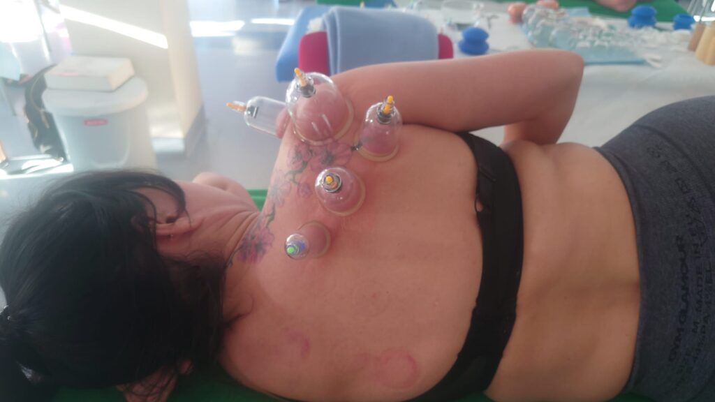 Terapia bańkami próżniowymi